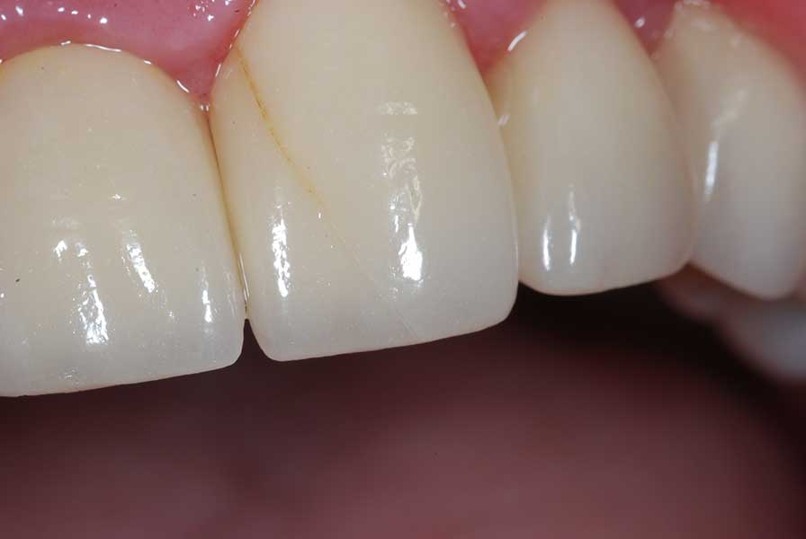 Dental Crowns & Bridges in London Ontario 3 Close-up of porcelain crowns matched to the shade of the natural teeth