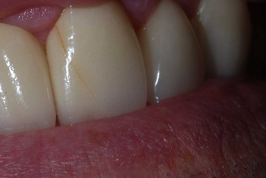 Root Canal Treatments in London Ontario 4 Porcelain crown placed to protect a tooth after root canal treatment