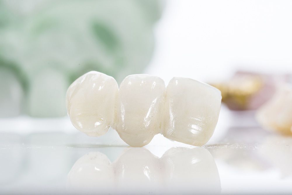 Crowns and Bridges in London, Ontario: Restoring Damaged Teeth 1 Dental crowns and bridges used to restore damaged and missing teeth in London, Ontario