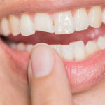 Broken Chipped Or Cracked Teeth