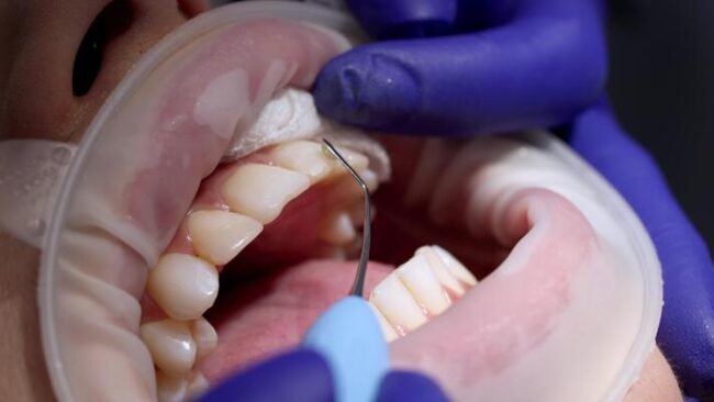 Teeth cleaning during a dental visit in London, Ontario