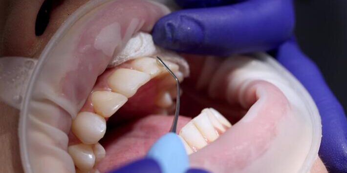 Teeth cleaning during a dental visit in London, Ontario