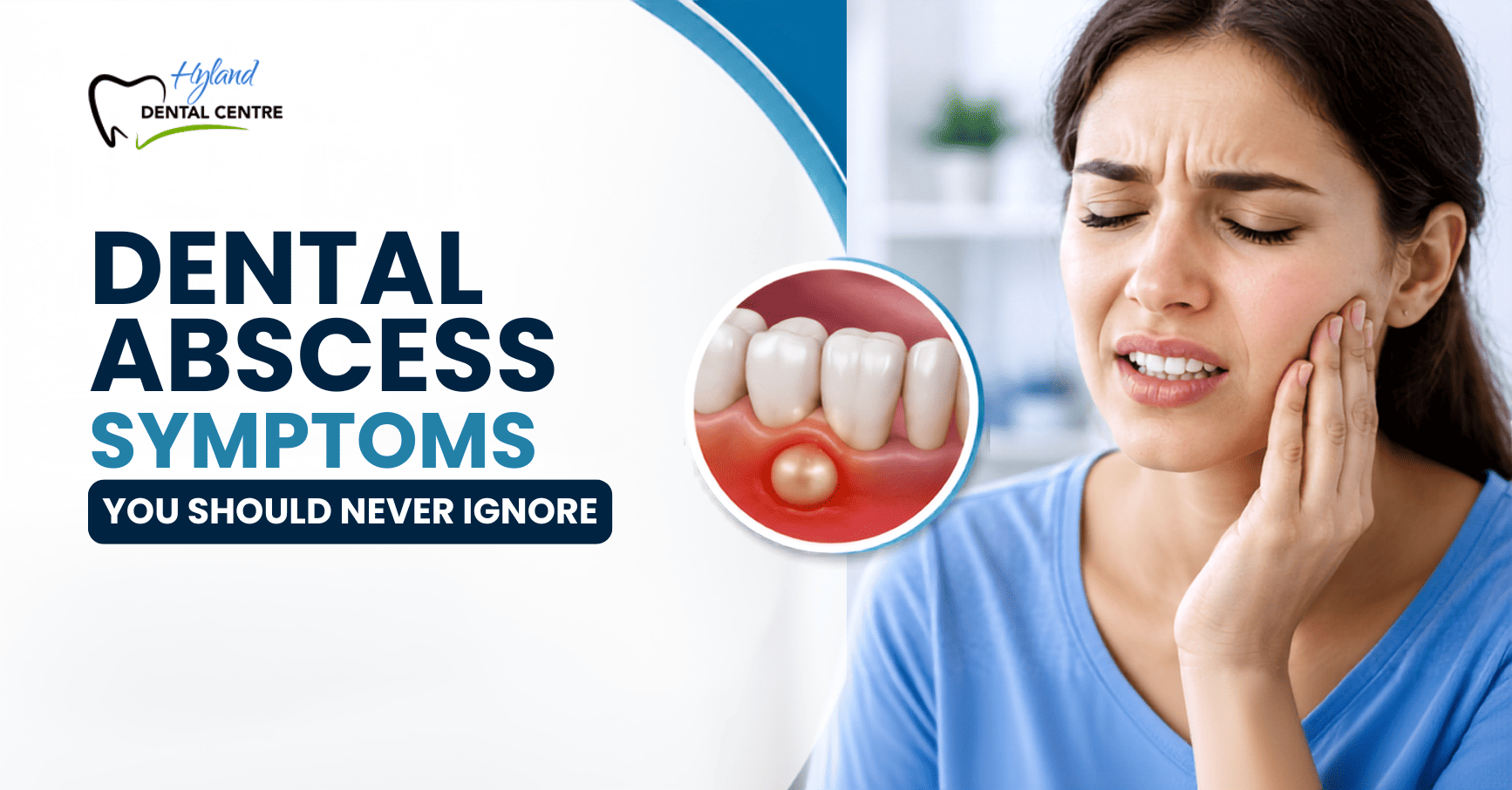 Chipped, Cracked, or Broken Tooth? What to Do Before Seeing a Dentist 1 Broken tooth assessment in London, Ontario