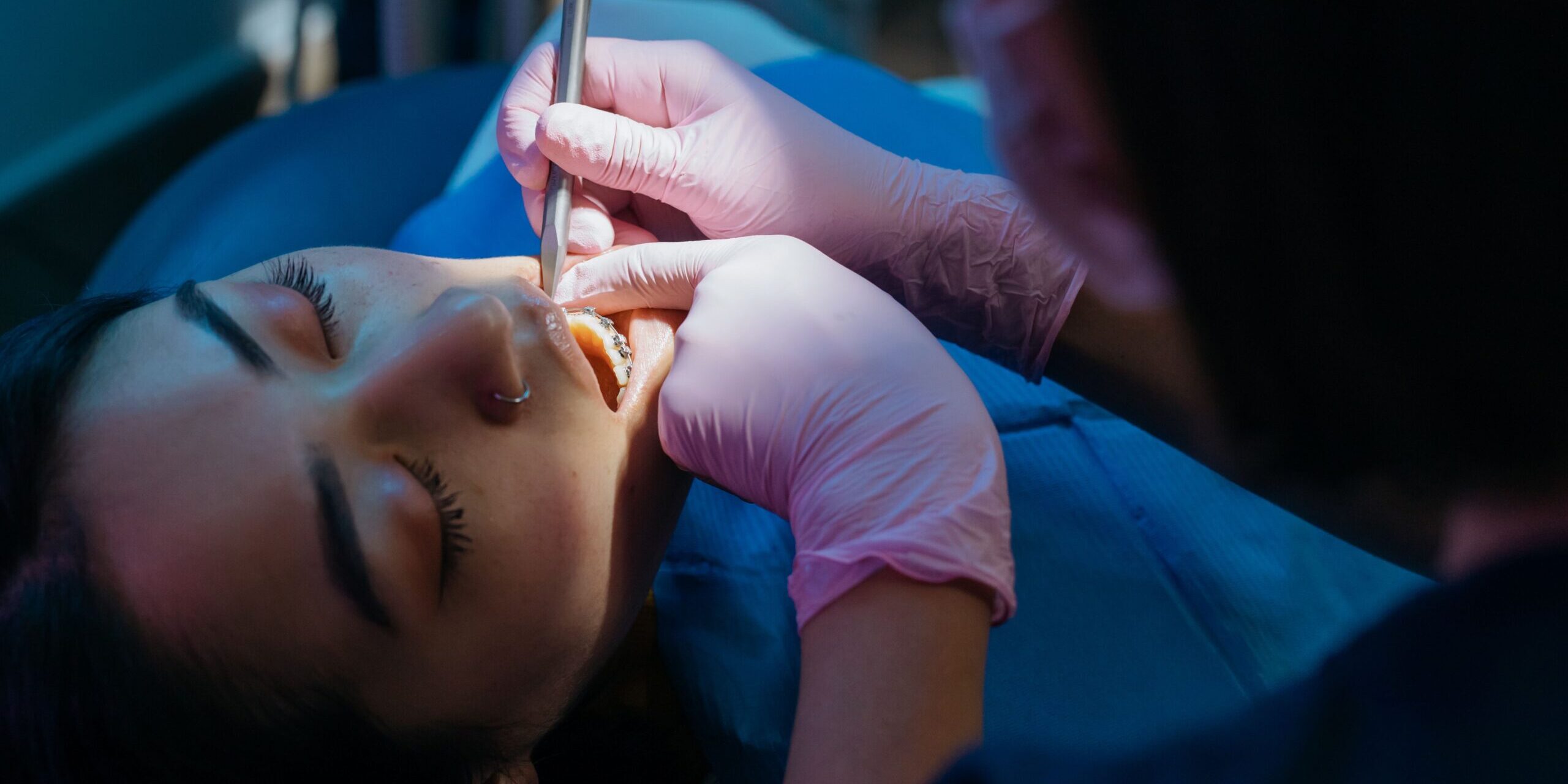 chipped-cracked-broken-tooth-london-ontario chipped-cracked-broken-tooth-london-ontario